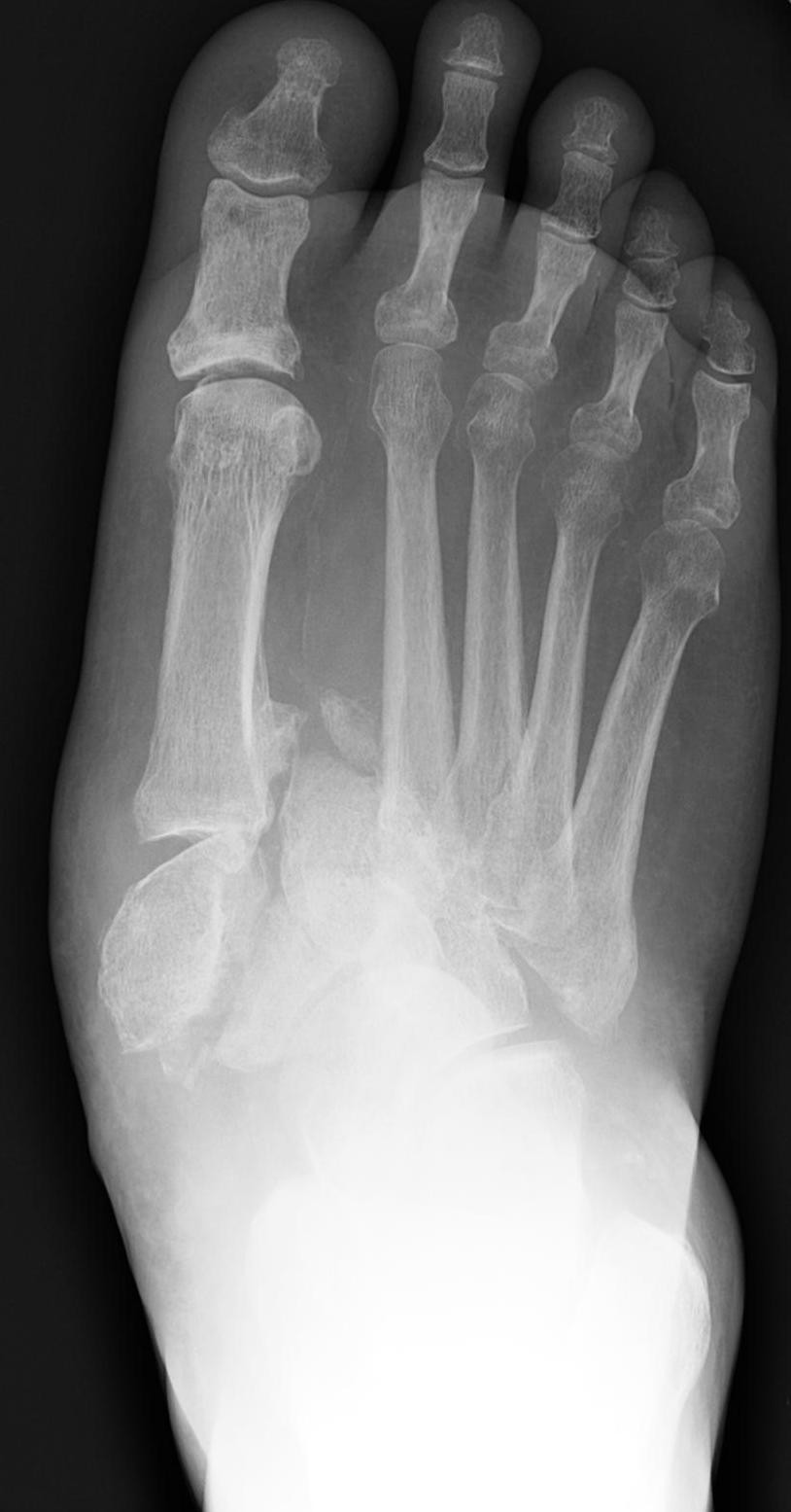 Charcot foot reconstruction with combined internal and ...