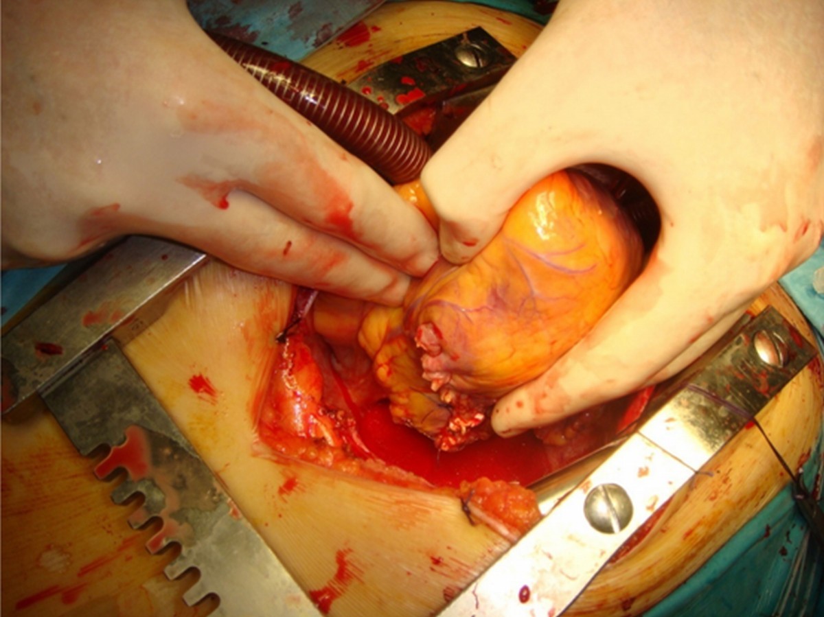 heart obliteration procedure