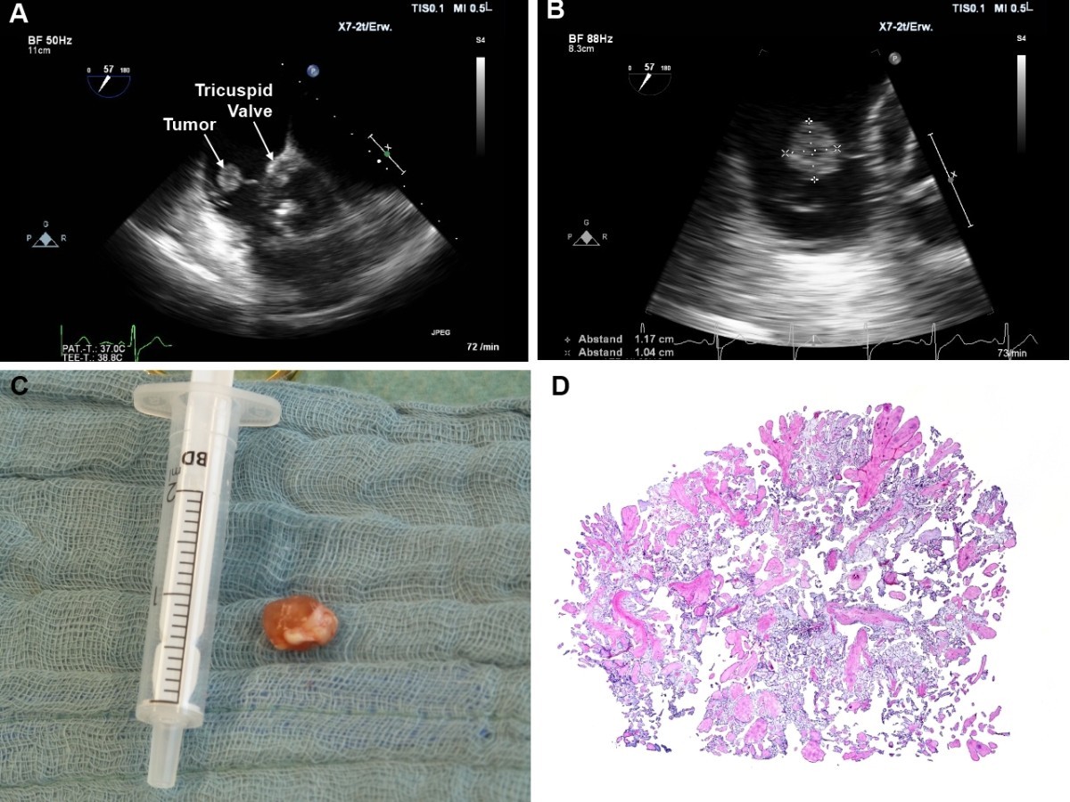 Incidental papillary fibroelastoma of the tricuspid valve | Journal of