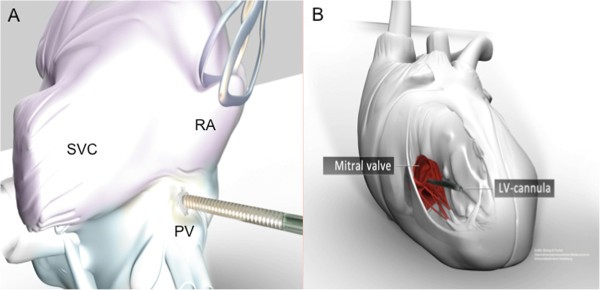 Central extracorporeal life support with left ventricular decompression for the treatment of ...