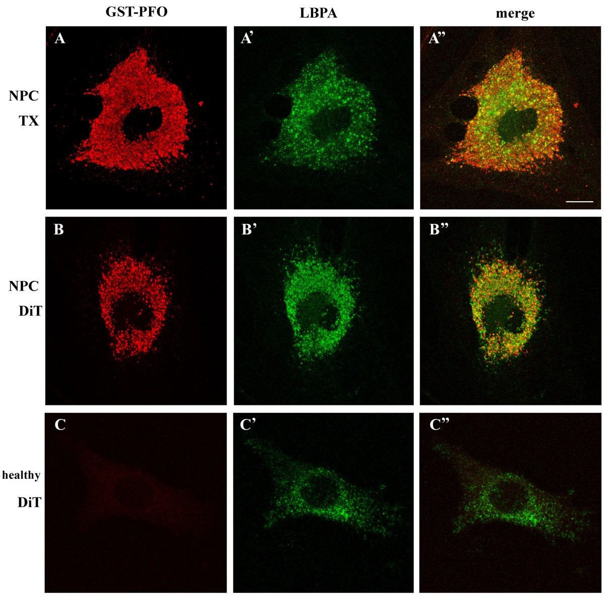 Visualization Of Cholesterol Deposits In Lysosomes Of Niemann Pick Type C Fibroblasts Using Recombinant Perfringolysin O Orphanet Journal Of Rare Diseases Full Text