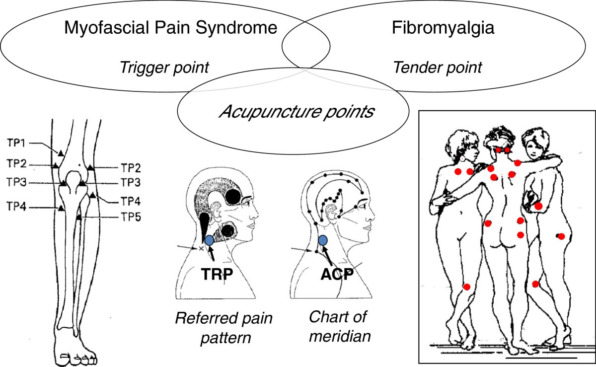 Fibromyalgia Tender Points Chart