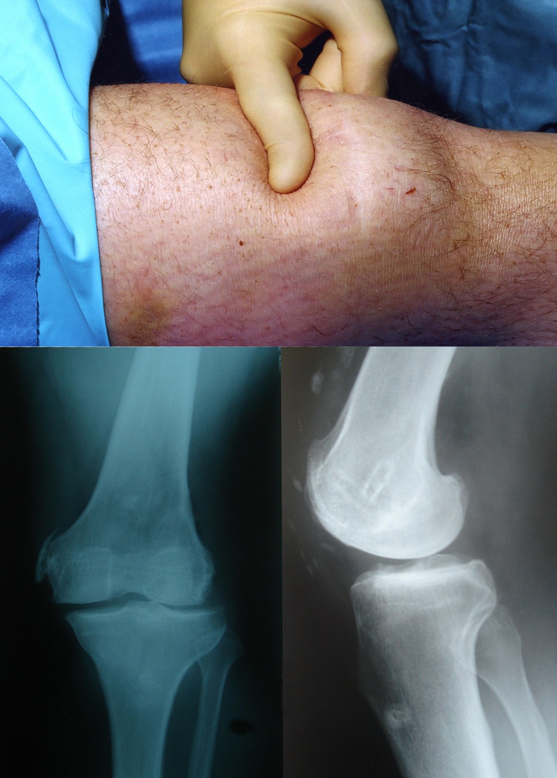 Traumatic quadriceps rupture in a patient with patellectomy: a case