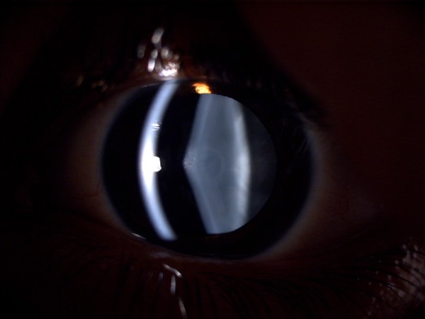 phacoemulsification case report We are a full-service ophthalmologist office providing eye exams, lasik surgery, cataract and glaucoma treatment call (808) 531-8874 in honolulu, hi. phacoemulsification case report We are a full-service ophthalmologist office providing eye exams, lasik surgery, cataract and glaucoma treatment call (808) 531-8874 in honolulu, hi.