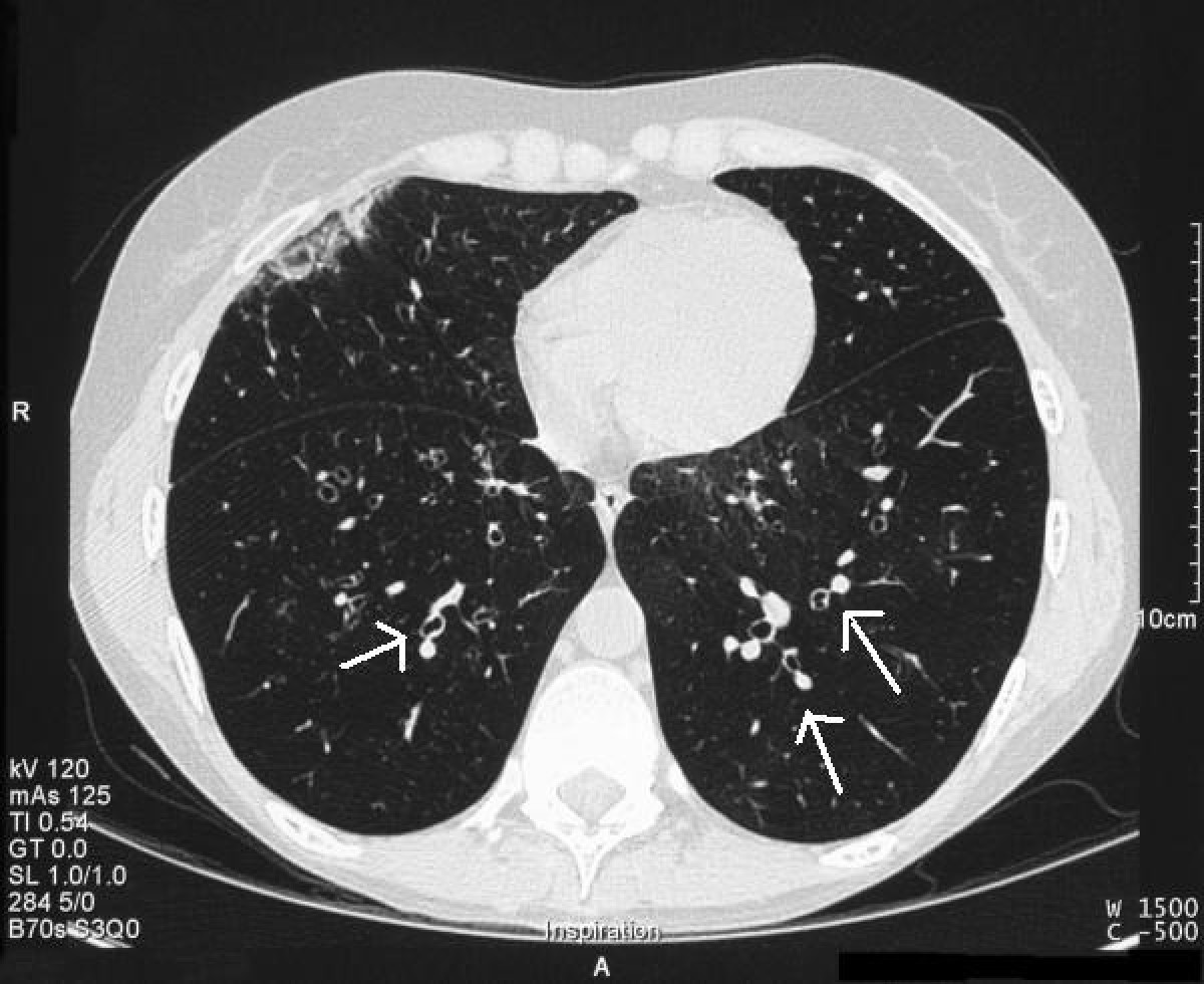 Bronchiectasis — The Intern at Work