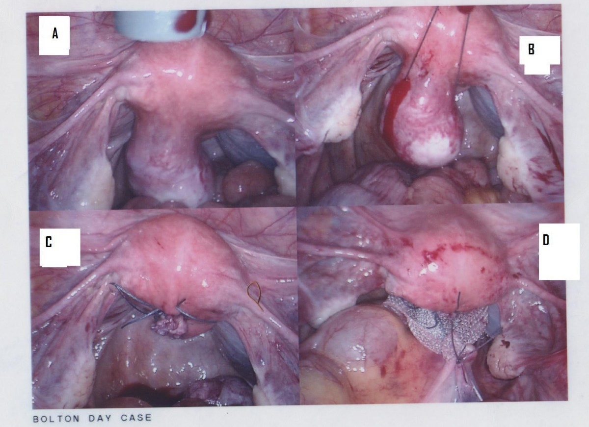 Imaging Of Endometrial And Cervical Cancer