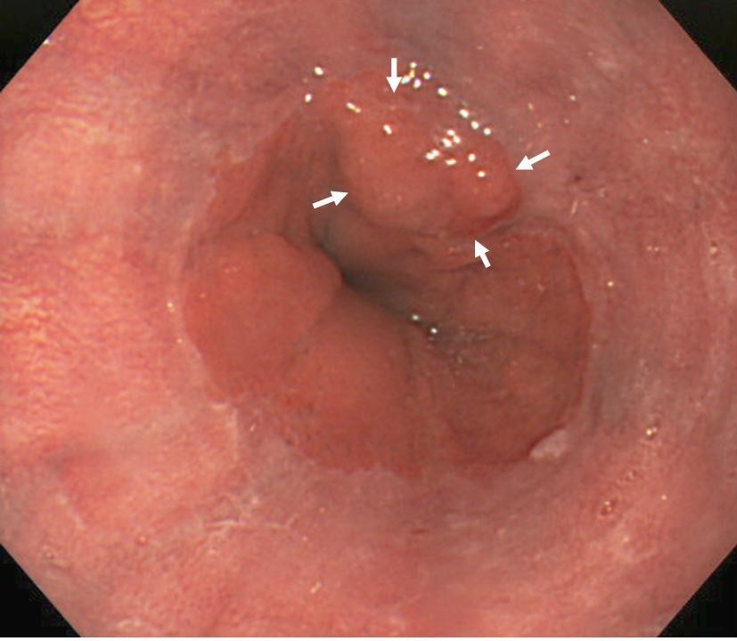 Endoscopic therapy using an endoscopic variceal ligation for minute