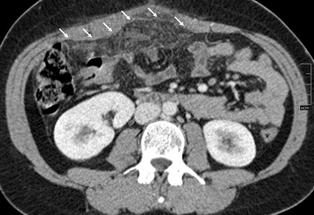Omental infarction in the postpartum period a case report and a review
