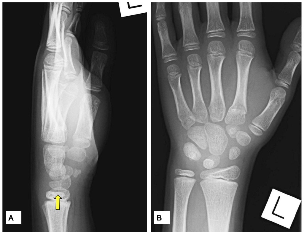 Congenital bipartite lunate presenting as a misdiagnosed lunate