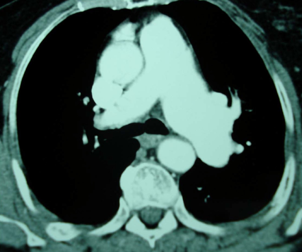 Lowpressure pulmonary artery aneurysm presenting with pulmonary