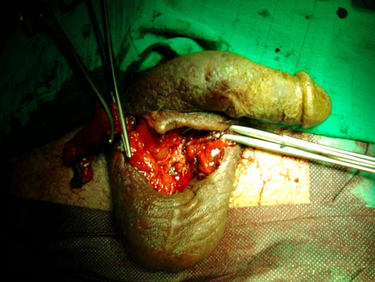 Bilateral testicular self-castration due to cannabis abuse: a case