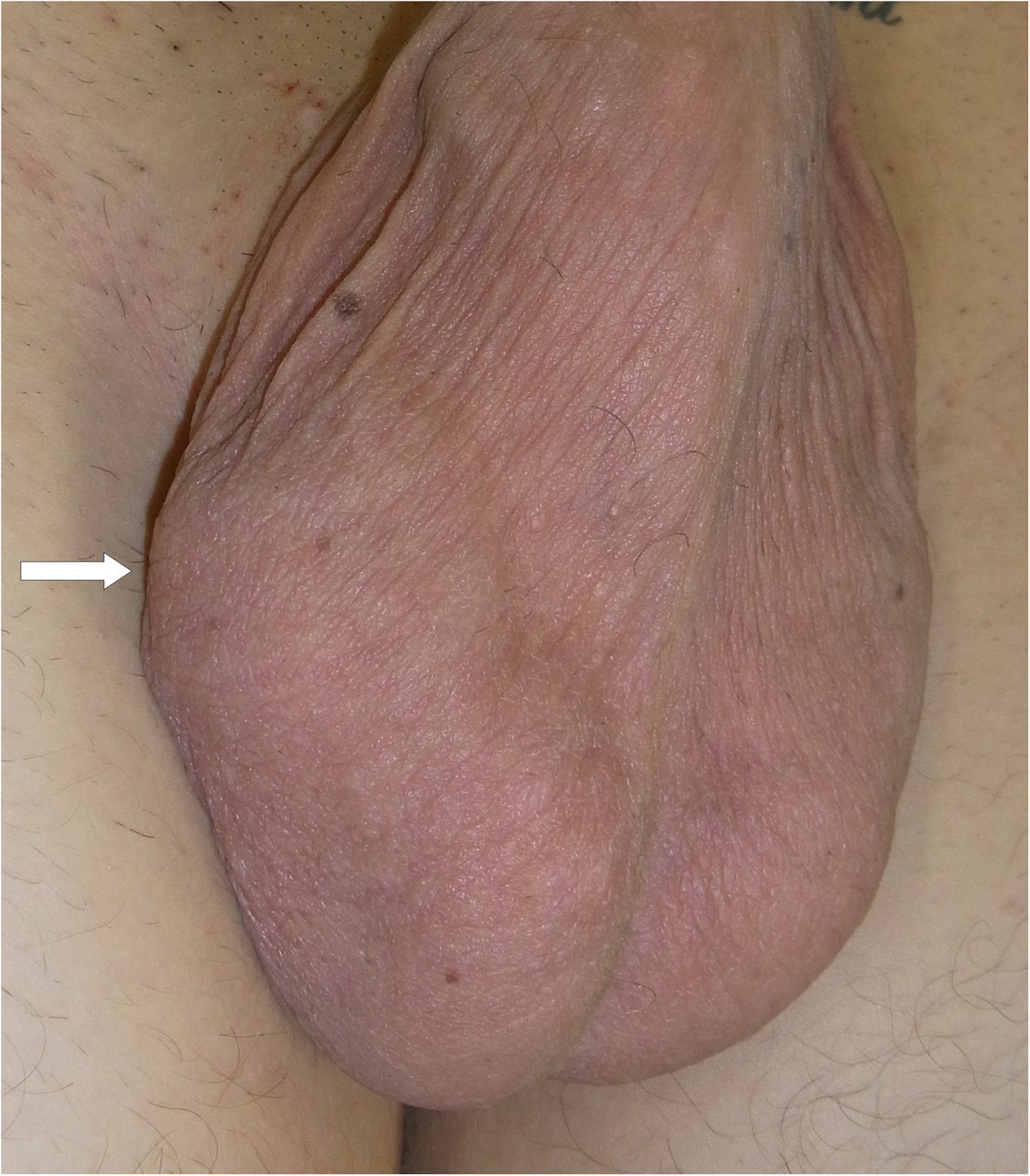 Clinical view: note the intrascrotal mass located cephalad to the right tes...