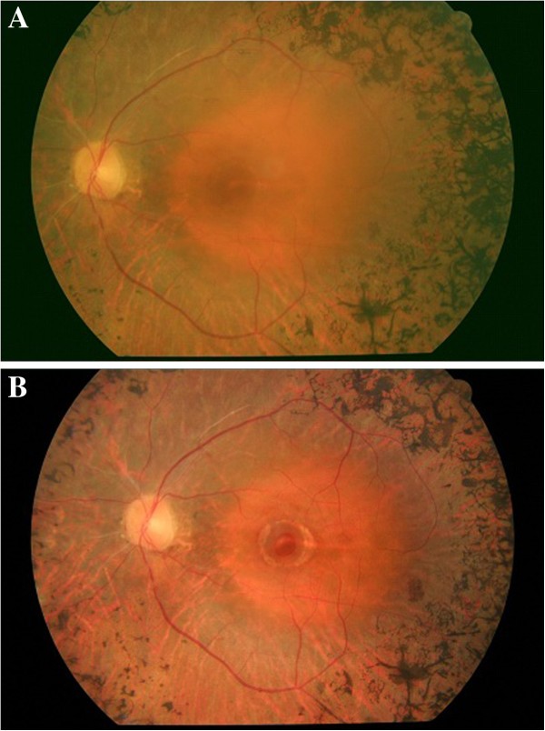 retinal atrophic hole