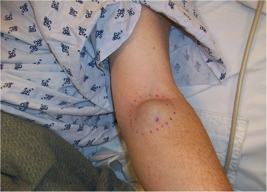 Extramedullary progression of multiple myeloma despite concomitant