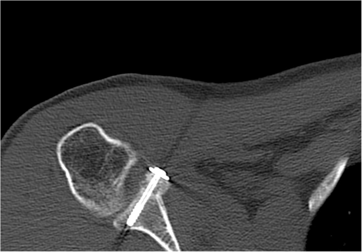 Avulsion fracture of the coracoid process in a patient ...