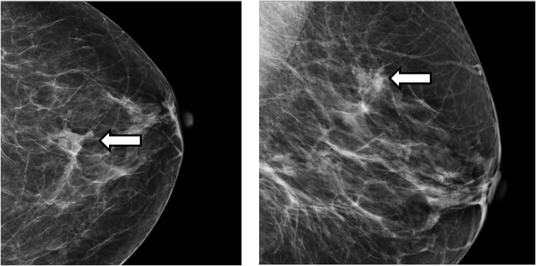 Округлые кальцинаты. Маммография микрокальцинаты. Кальцинаты на маммографии. Фиброаденома молочной железы маммография. Протоковая карцинома молочной железы маммография.