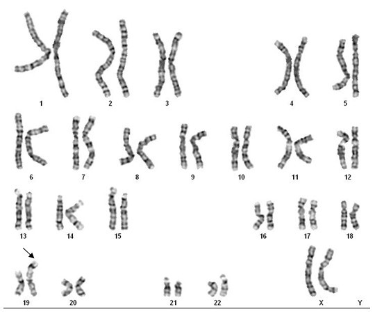 Спаривание хромосом. Хромосомы человека для фона. Цитогенетика. Филадельфийская хромосома в клетках. Х19 хромосома.