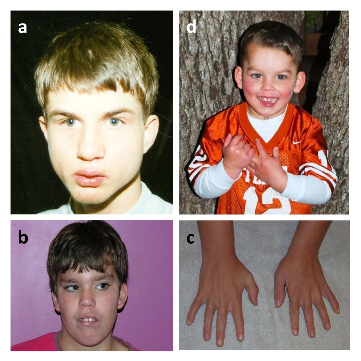Deletions in chromosome 6p22.3p24.3, including ATXN1, are associated
