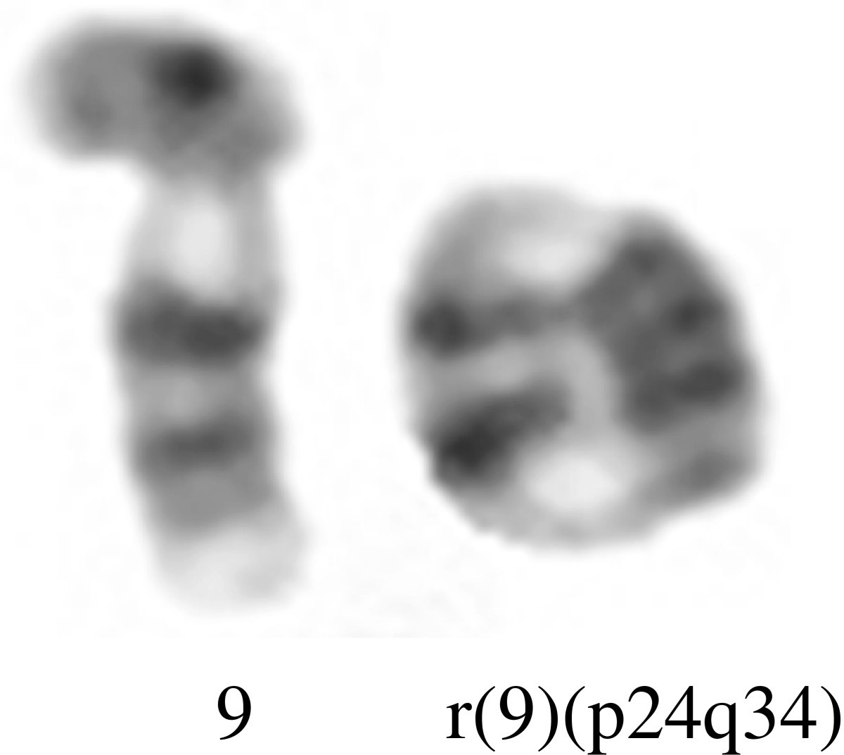 Спаривание хромосом. Делеция короткого плеча 9 хромосомы.
