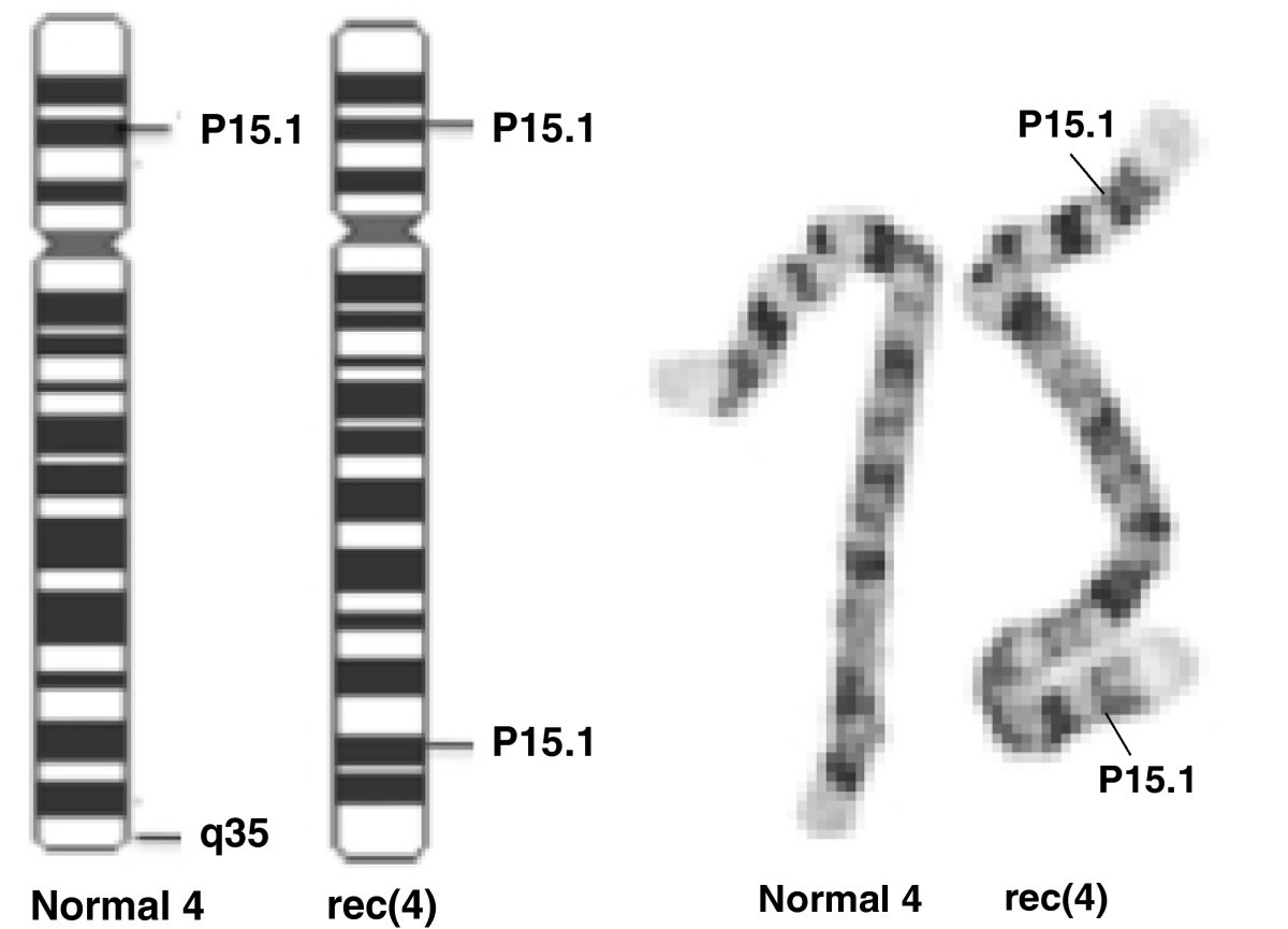 Спаривание хромосом. 4 Хромосома. 4p16.3 хромосома. Делеция плеча 4 хромосомы.