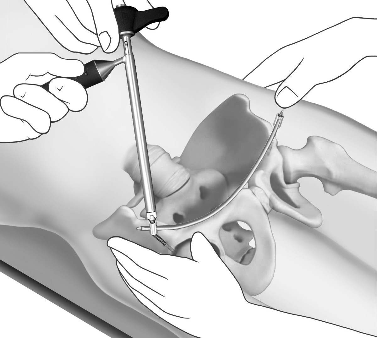 Minimally invasive internal fixation for unstable pelvic ring fractures: a  retrospective study of 27 cases | Journal of Orthopaedic Surgery and  Research | Full Text