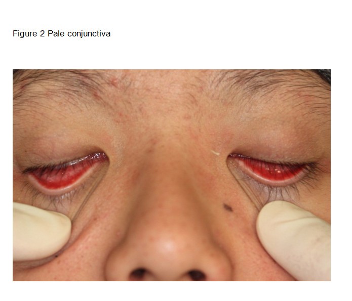 pale conjunctiva