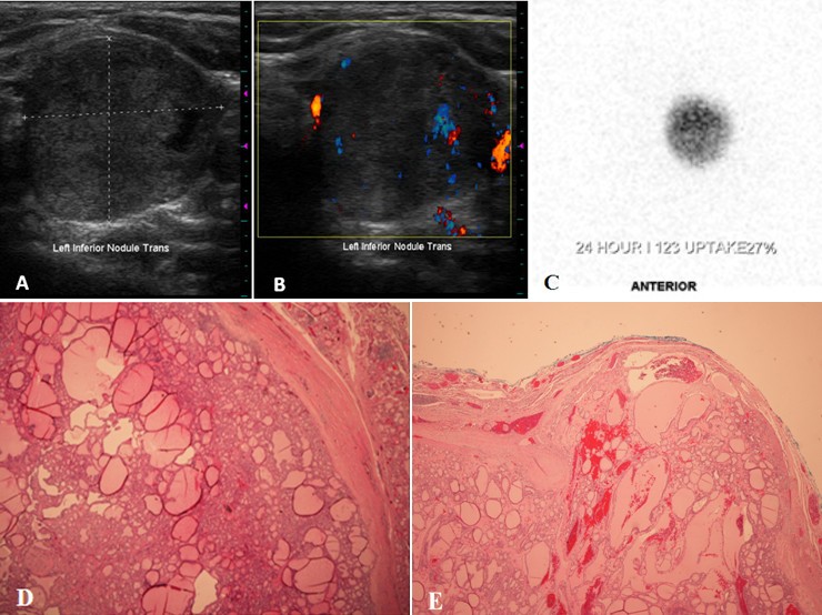 A solitary hyperfunctioning thyroid nodule harboring thyroid carcinoma