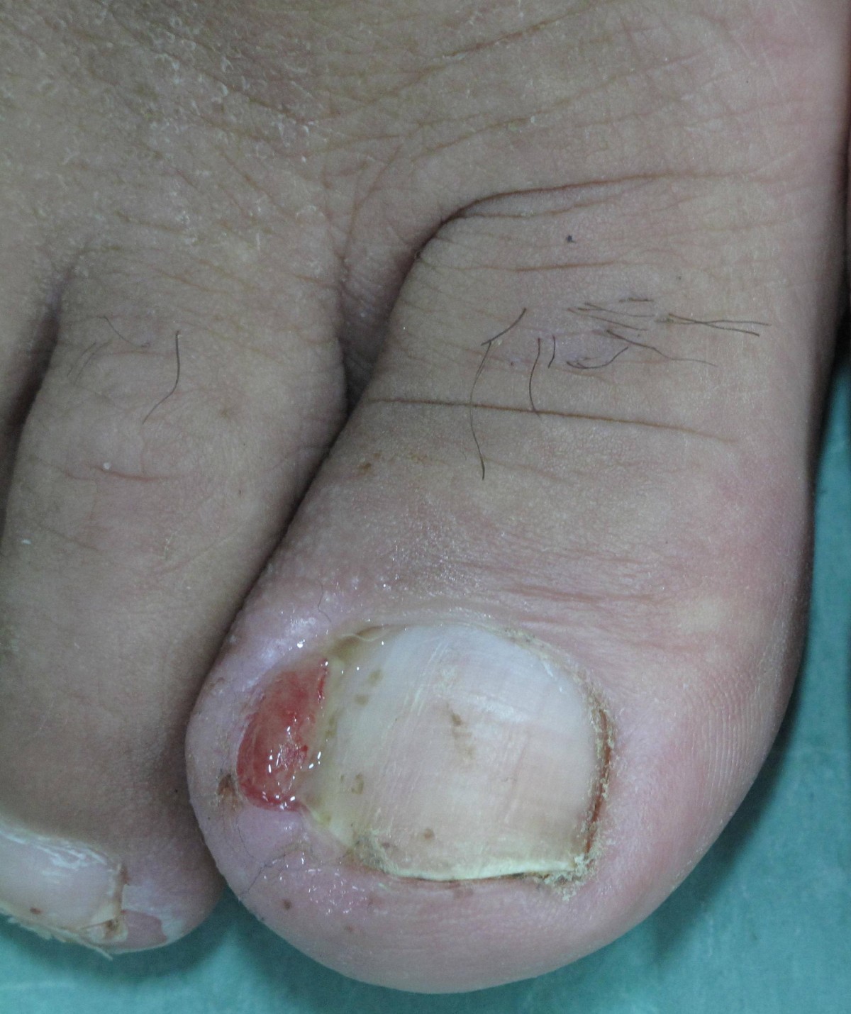 Chemotherapy and skin reactions Journal of Experimental & Clinical