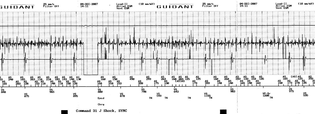 Programmed inappropriate ICD ventricular defibrillation for cardioversion of persistent atrial ...