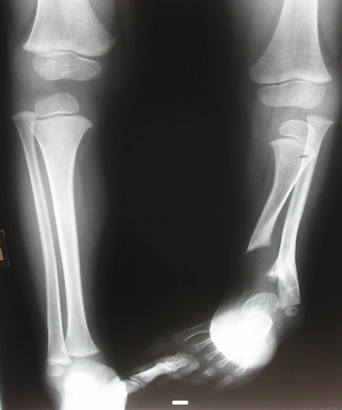 A CASE OF UNILATERAL TIBIAL HEMIMELIA WITH UNILATERAL RADIAL CLUB