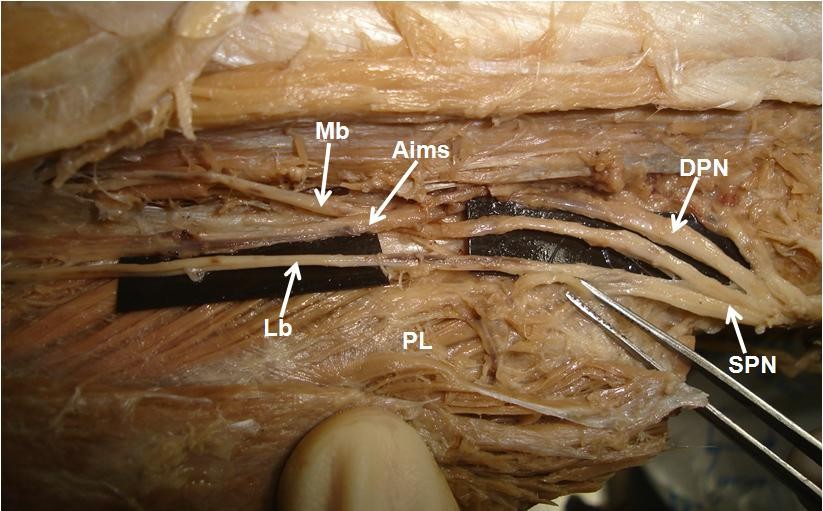Anomalous superficial peroneal nerve and variant cutaneous innervation