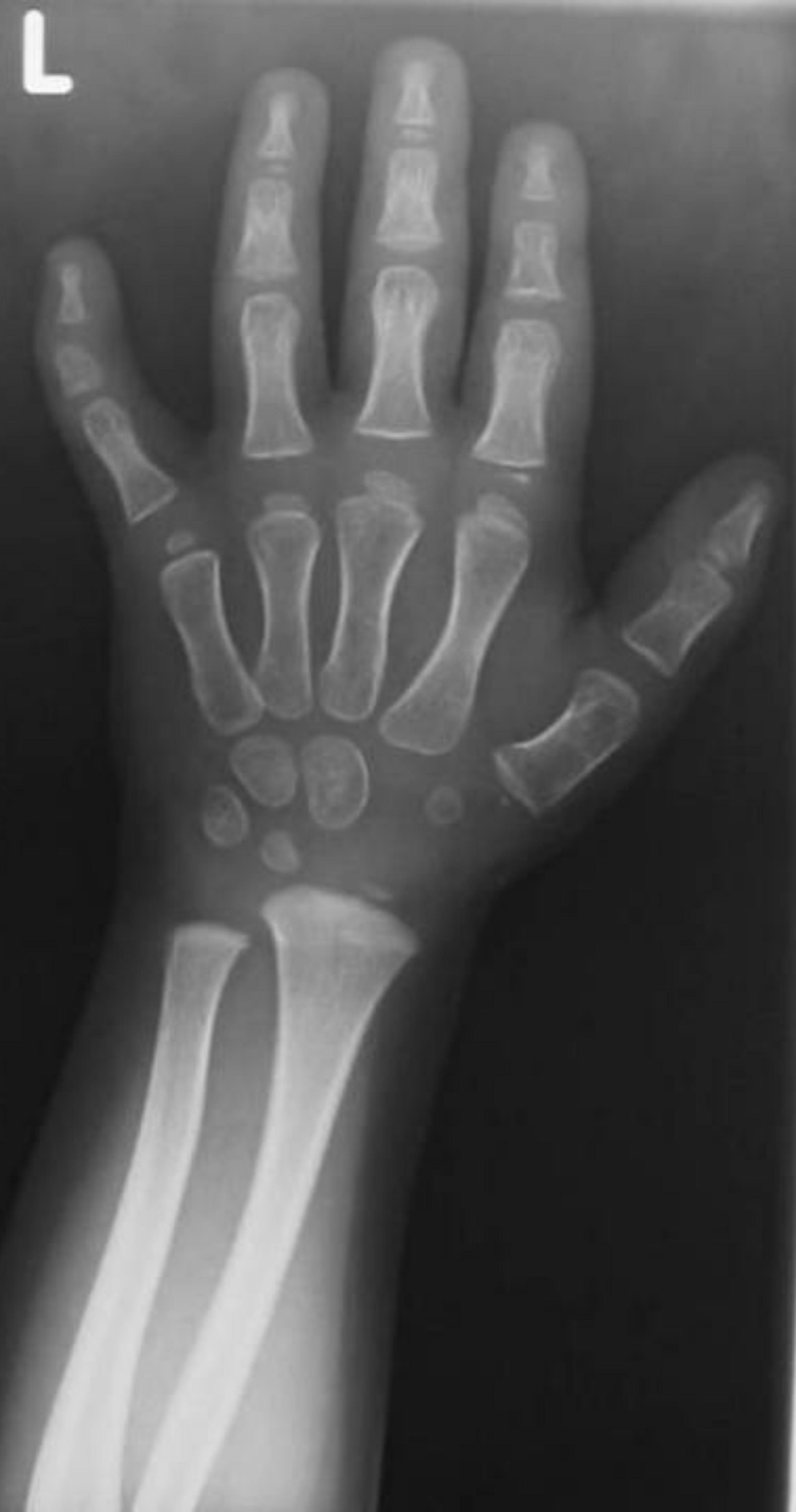 ossification of carpal bones