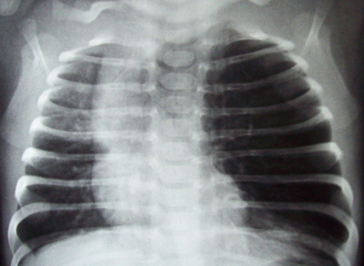 Congenital lobar emphysema a case report Cases Journal Full Text