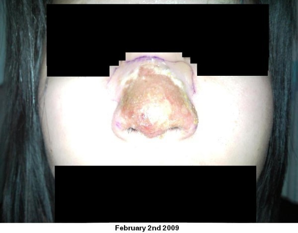 An Immunocompetent Patient Presenting With Severe Nasal Herpes