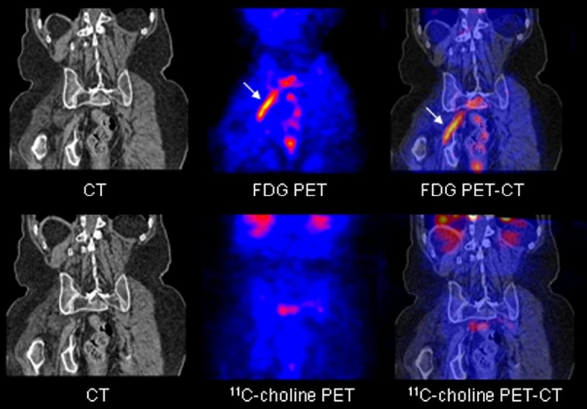 Разница кт и кт с контрастом. ПЭТ кт здорового человека снимки. Позитрон-эмиссионная  томография: ПЭТ. ПЭТ/кт с туморотропными РФП (18f-фтордезоксиглюкоза).