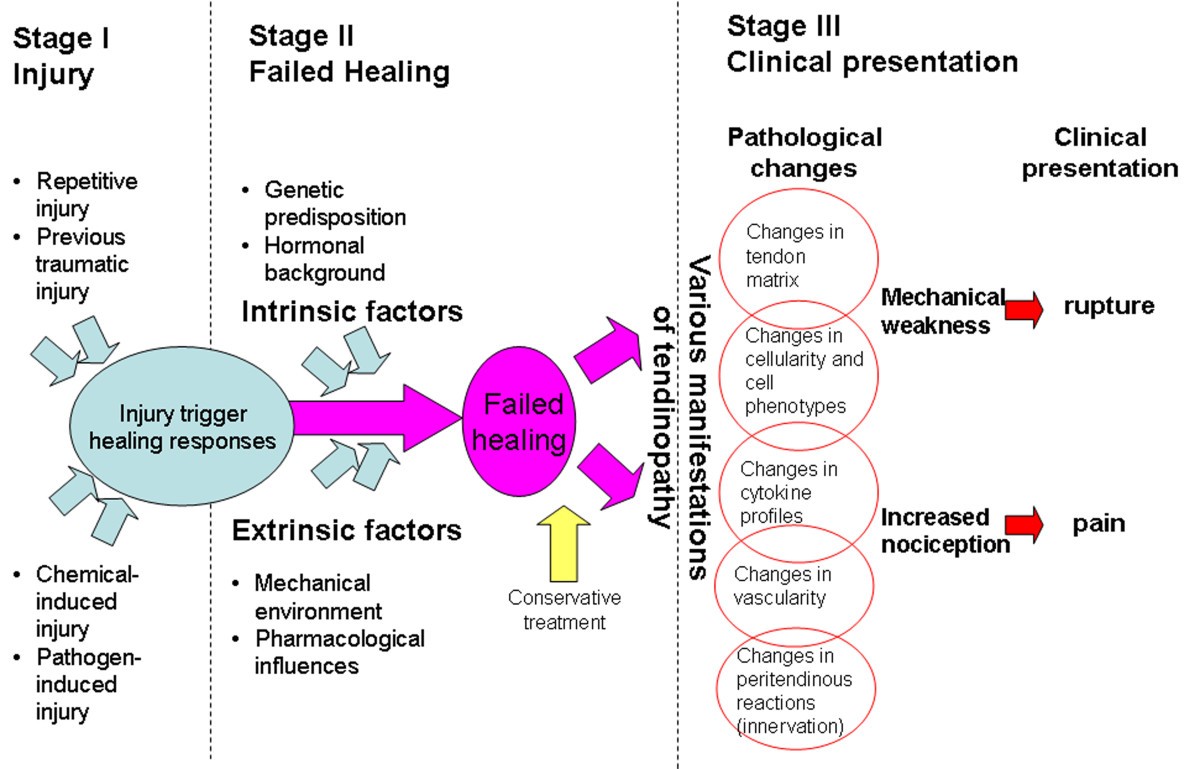 Stages of process. Tendinopathy. Stage failed. Hormonal changes.