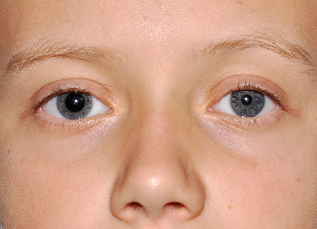 Какой глаз левый а какой правый. Миоз мидриаз анизокория. Анизокория врожденная.