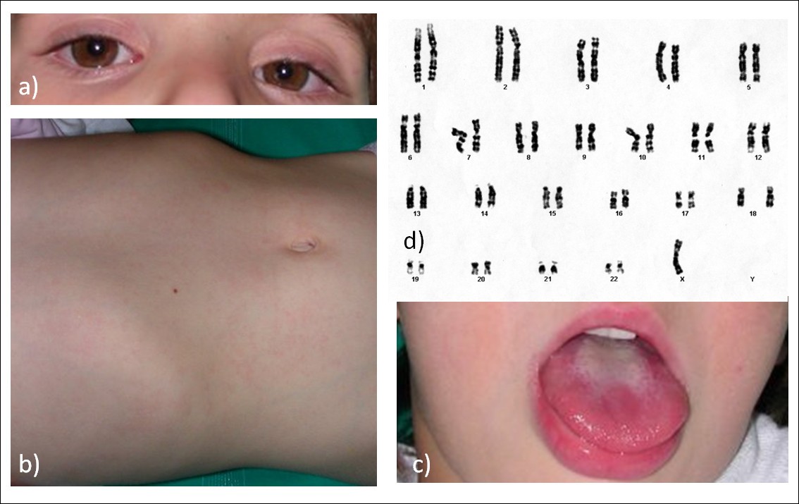 Kawasaki disease in a girl with turner syndrome: a remarkable association |  Italian Journal of Pediatrics | Full Text