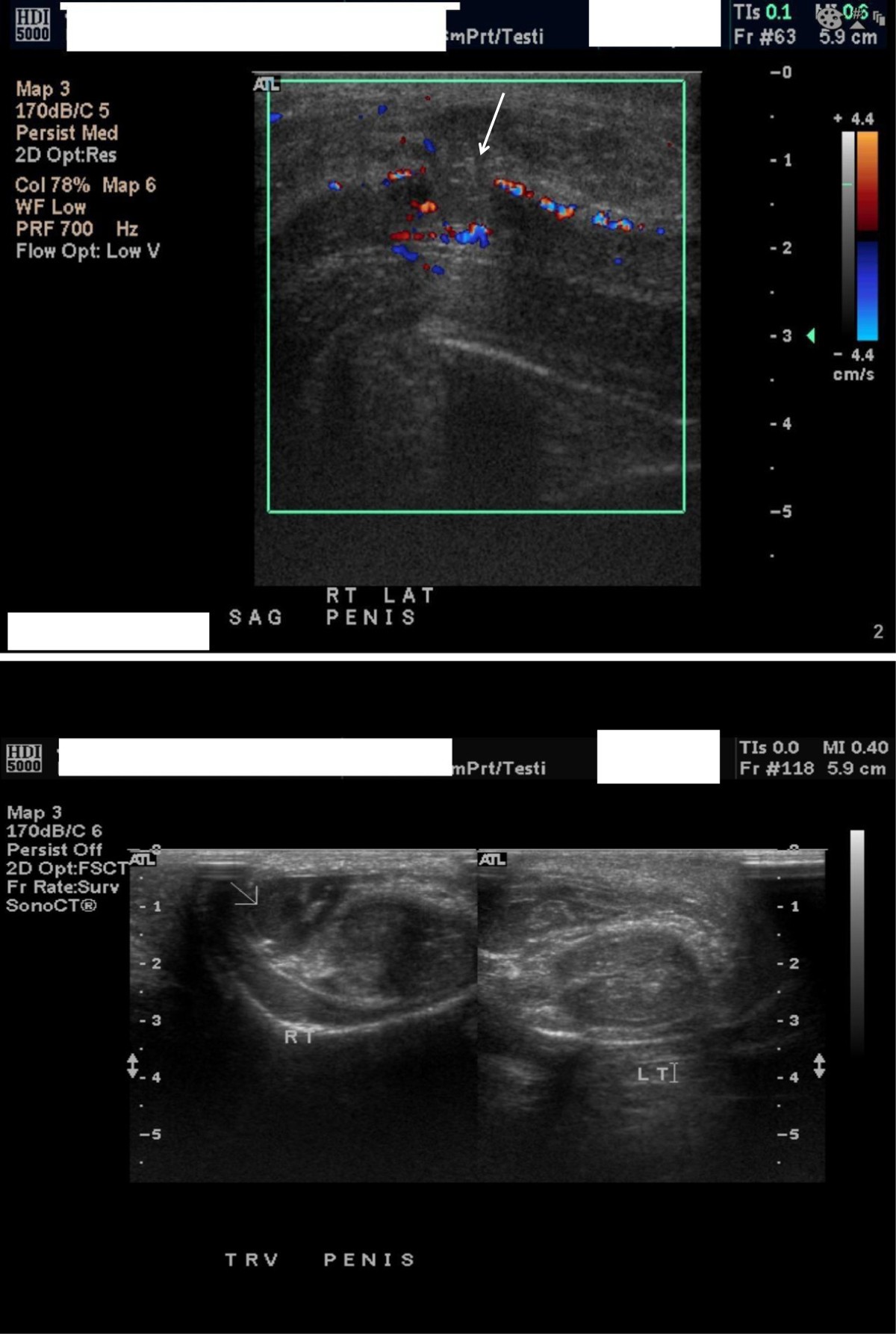 penile fracture healing time surgery