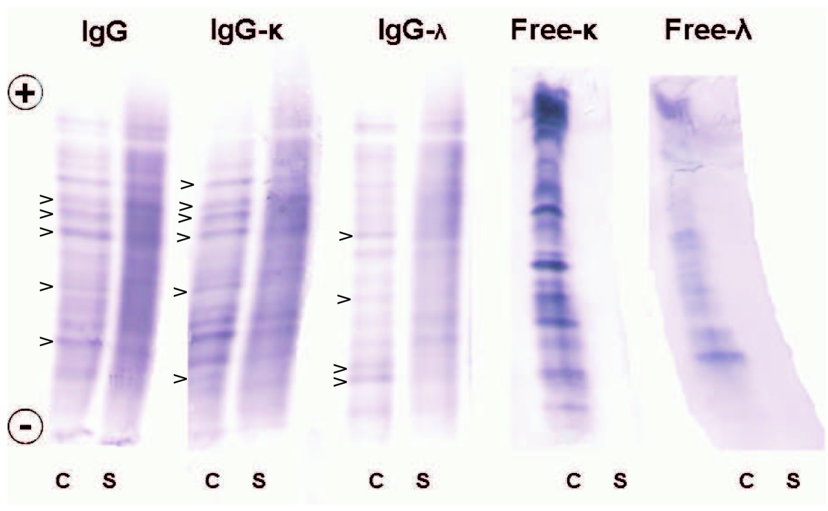 Detection of oligoclonal IgG kappa and IgG lambda bands in