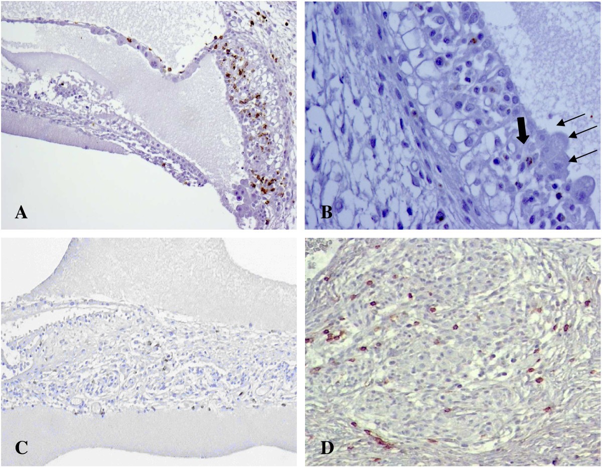 Human fetal inner ear involvement in congenital cytomegalovirus ...