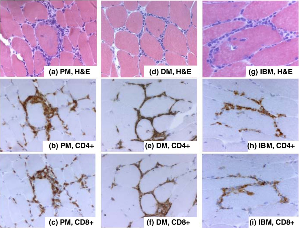 Immune mechanisms in the pathogenesis of idiopathic inflammatory myopathies  | Arthritis Research & Therapy | Full Text