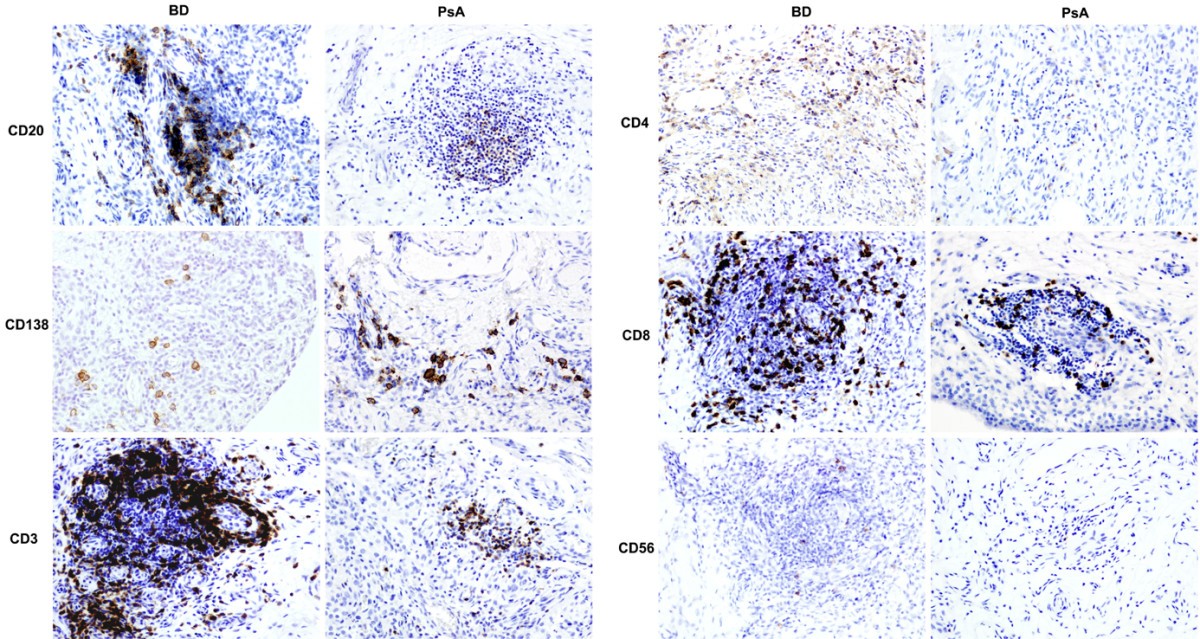 Distinct synovial immunopathology in Behçet disease and psoriatic arthritis  | Arthritis Research & Therapy | Full Text