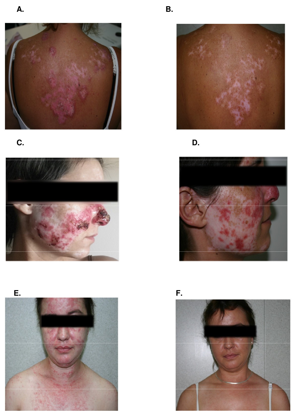 Efficacy And Safety Of Lenalidomide For Refractory Cutaneous Lupus