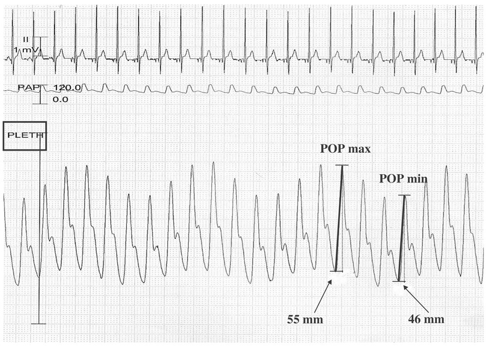 Relation between respiratory variations in pulse oximetry