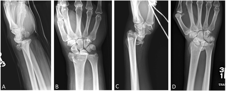 Volar barton fracture