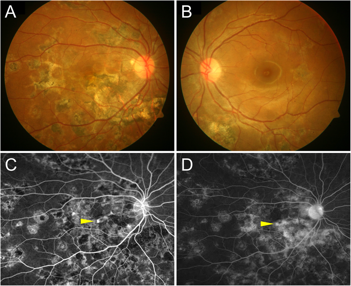 Гистоплазмоз глазного дна. Неоваскуляризация сетчатки. Диабетическая ретинопатия фаза неоваскуляризации. Макулопатия глаза
