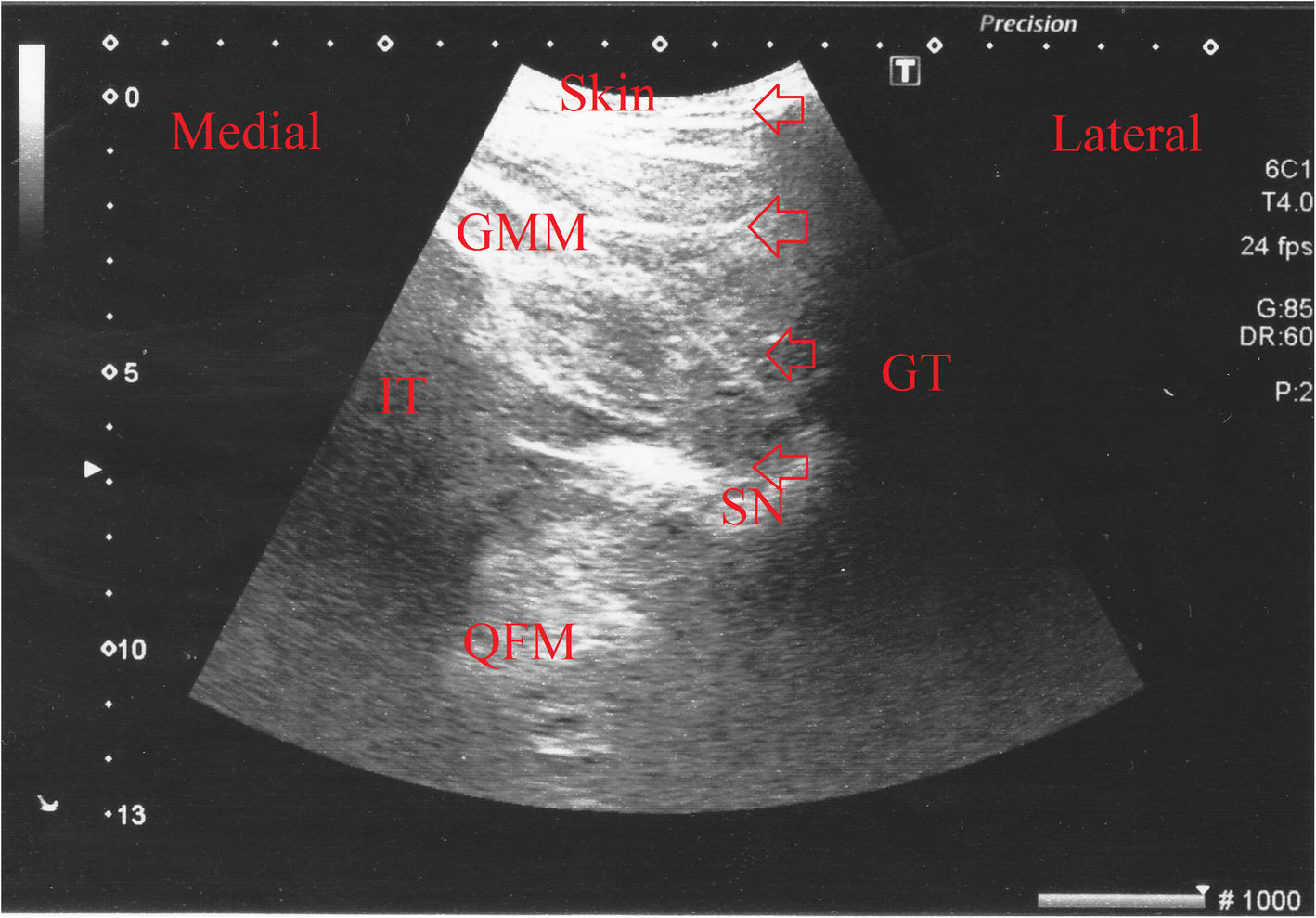 sciatic nerve block anterior approach