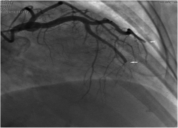 Left ventricular mural thrombus and dual coronary embolization associated with hyperthyroid ...