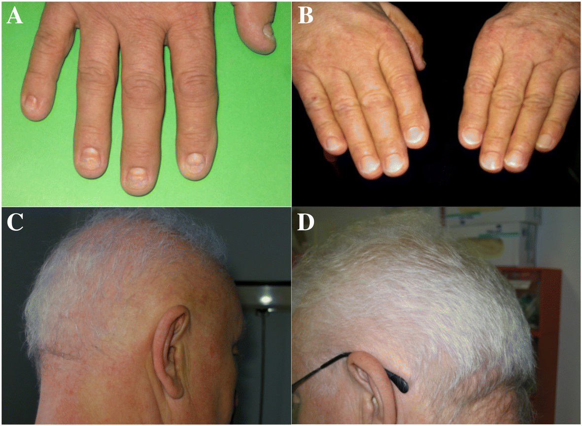 Recovery of Alopecia Universalis with Associated Nail Dystrophy Treated  with Tofacitinib: A 6‑year‑old Child's Case Report